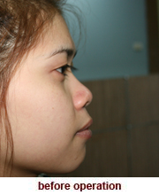 plastic_surgery_augmentation_rhinoplasty